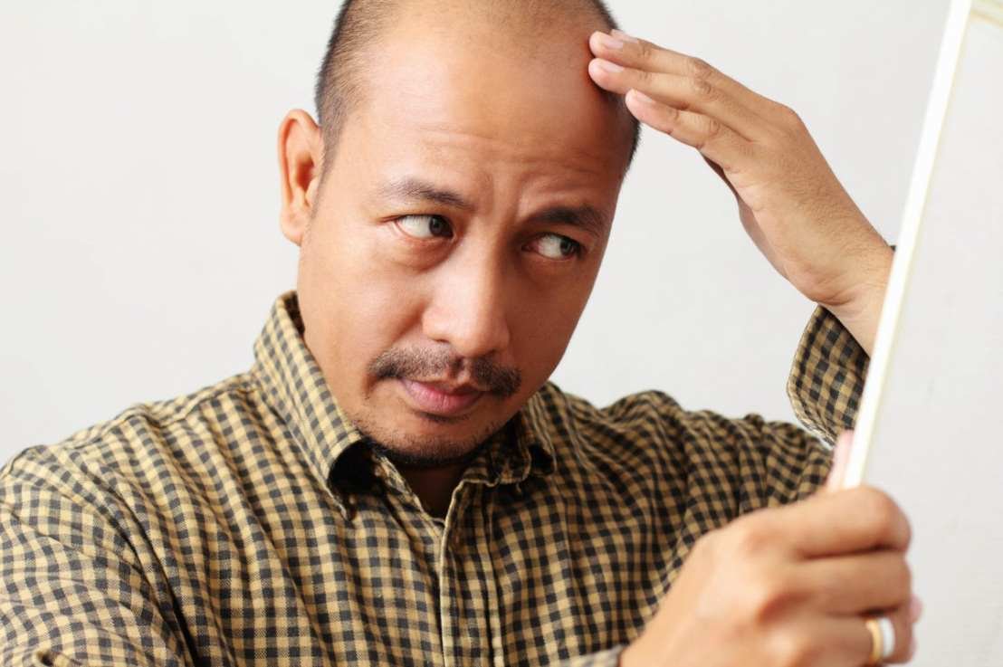 Treating Male pattern baldness